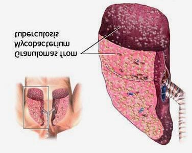 Figure 2: Latent Tuberculosis Infection (LTBI) [55].