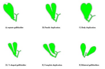 Figure 1: Boyden’s classification of gallbladder anatomical variations.