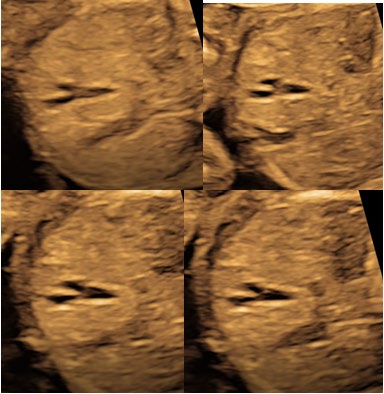 Figure 2: Two fluid-filled; parallel double tubular structures with anterior blind ending with sludge in the right upper quadrant of the liver; Duplicated Gall Bladder (Bodyen’s – Y shaped gall bladder) in Twin I.