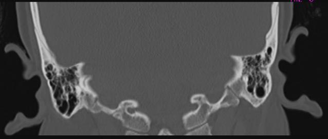 Figure 1: Arrow Pointing To The Elevated Amplitude at Low Threshold In Vemp.