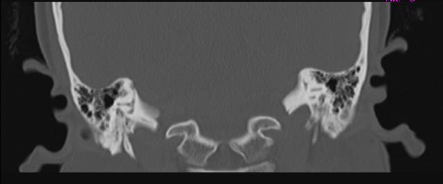 Figure 2: HRCT Temporal Bone, Coronal and Axial Scans Illustrating Dehiscence of the Right Posterior Semicircular Canal at Its Dome. The Bony Dehiscence Is Seen Extending Anteriorly till the common crus with the superior semicircular canal.