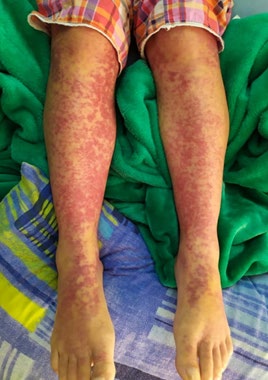 Figure 4: Confluent erythematous maculopapular rash in both legs.