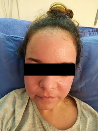 Figure 5: Confluent erythematous maculopapular rash in left arm.