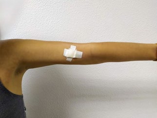 Figure 8: Rash remission in day 14.