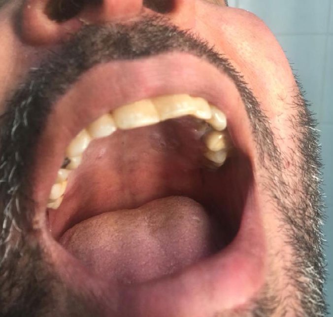 Figure 3: Oral mucosal involvement.