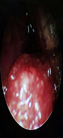 Figure 1: View on Diagnostic nasal endoscopy.