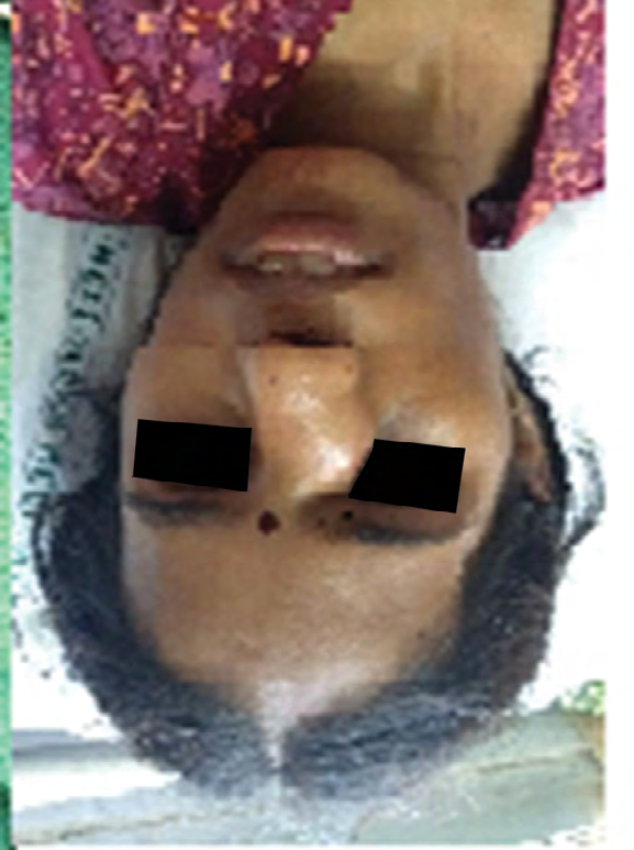 Figure 2: Pre-operative lesion.