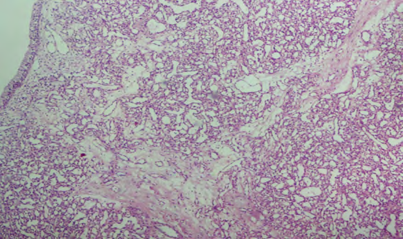 Figure 4: Low power view of section showing respiratory lining with underlying mucosa showing lobules of irregularly shaped vascular spaces and ramifying capillaries.