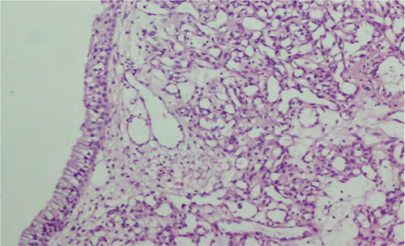 Figure 5: High power view showing cellular areas with tightly packed capillaries with plump endothelial lining.
