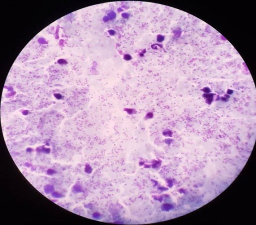 Figure 1: Thick film using Giemsa stain under the microscope.