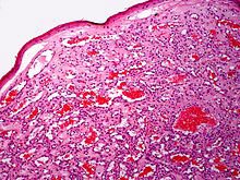 Figure 5: Cherry angioma demonstrating vascular configurations, red cell accumulation, and patent and collapsed vascular articulations and a superimposed squamous epithelium [13].