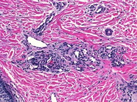 Figure 7: Tufted angioma depicting vascular arrangements lined by plump endothelium with intra-cavitary projections and a circumscribing, inflamed fibrous tissue stroma [15].