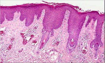 Figure 8: Port wine stain with dilated capillaries disseminated within the upper dermis with a superimposed squamous epithelium showing acanthosis, hyperkeratosis and elongation of rete ridges [16].