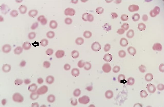 Figure 1: ** Basophilic stippling +3 arrowed, polychromasia.