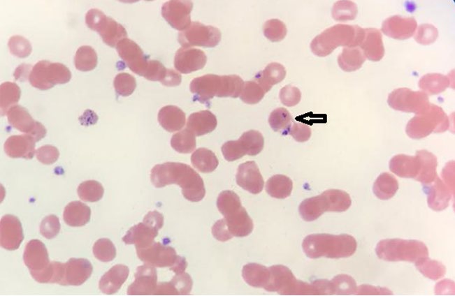 Figure 2: Maltase crosses of Babesia trophozoite inside red blood cells arrowed.