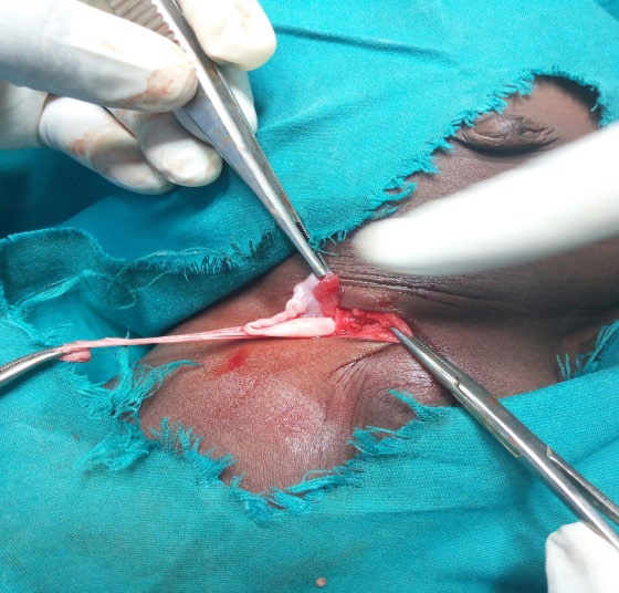 Figure 3: Intra operative picture of the 3rd patient showing the ovary and fallopian tube.