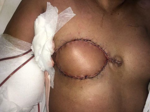 Figure 1: immediate after latissimus dorsi flap reconstruction.