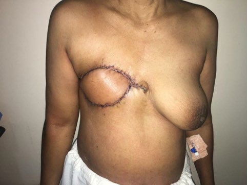 Figure 3: latissimus dorsi flap after 2 weeks.