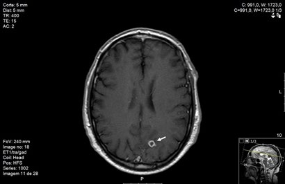 Figure 2: MRI revealing a cavitated image (arrow) with gadolinium ring enhancement surrounded by edema and erasure of the left medial parieto-occipital region grooves.