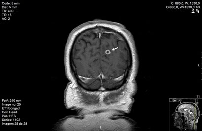 Figure 3: MRI revealing a cavitated image (arrow) with gadolinium ring enhancement surrounded by edema and erasure of the left medial parieto-occipital region grooves.