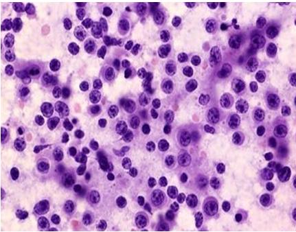 Figure 4: Testicular PNF image. Where irregular plasma cells with eccentric nuclei and large cytoplasm are seen on the hematic background.