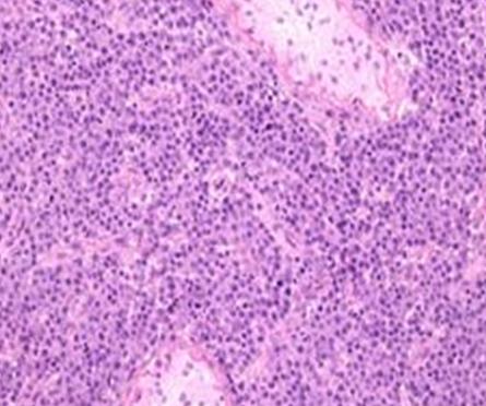 Figure 5: Testicular parenchyma clearance due to diffuse and disc-like proliferation of plasma cells.