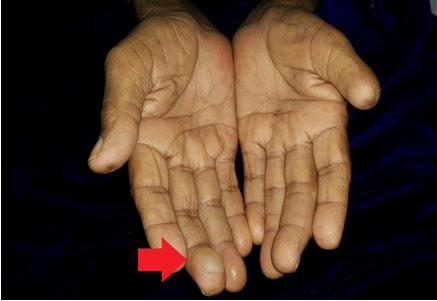 Figure 1: _Bullous diabeticorum_ on dorsal surface of hands as shown in Figure 2.