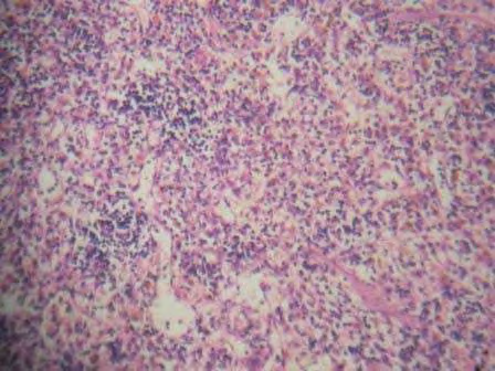 Figure 4: Group-D-Aegle marmelos fed rats beta cells islets of Langerhans showing slightly restoration of beta cells when compared to Diabetic control rats.