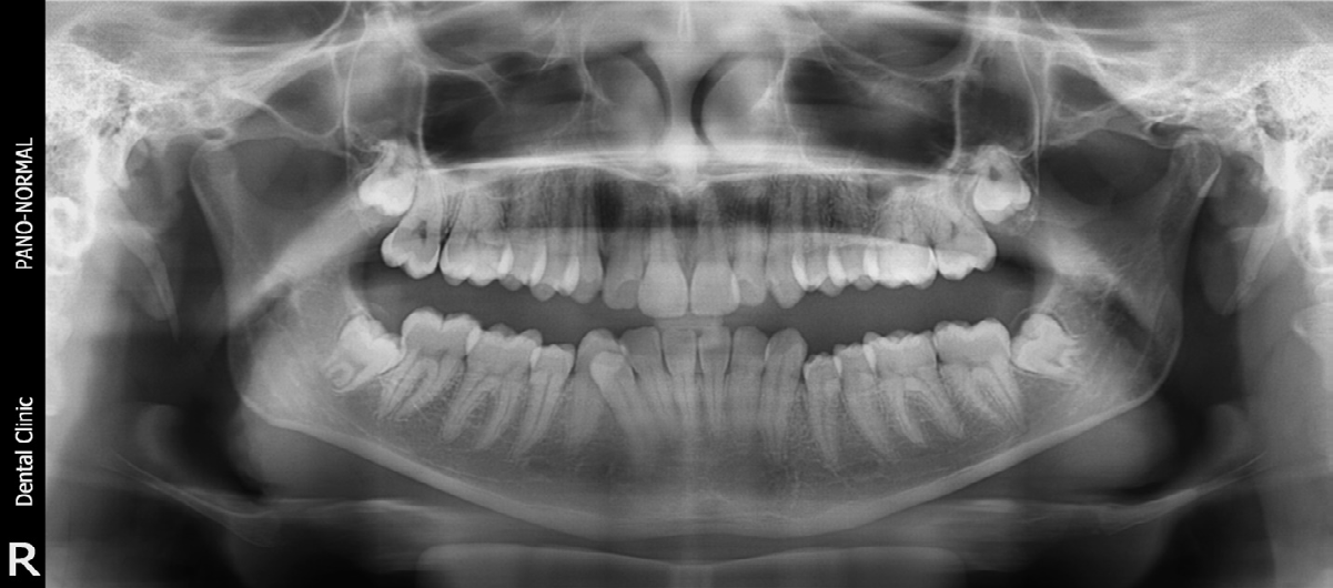 Figure 2: Orthopantomograph showing apical foramen closed.