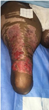 Figure 1: Raw area over the right thigh.