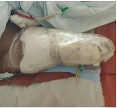 Figure 3: Modified CIS applied to wound.