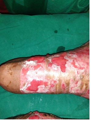 Figure 4: Healed wound over the right thigh.