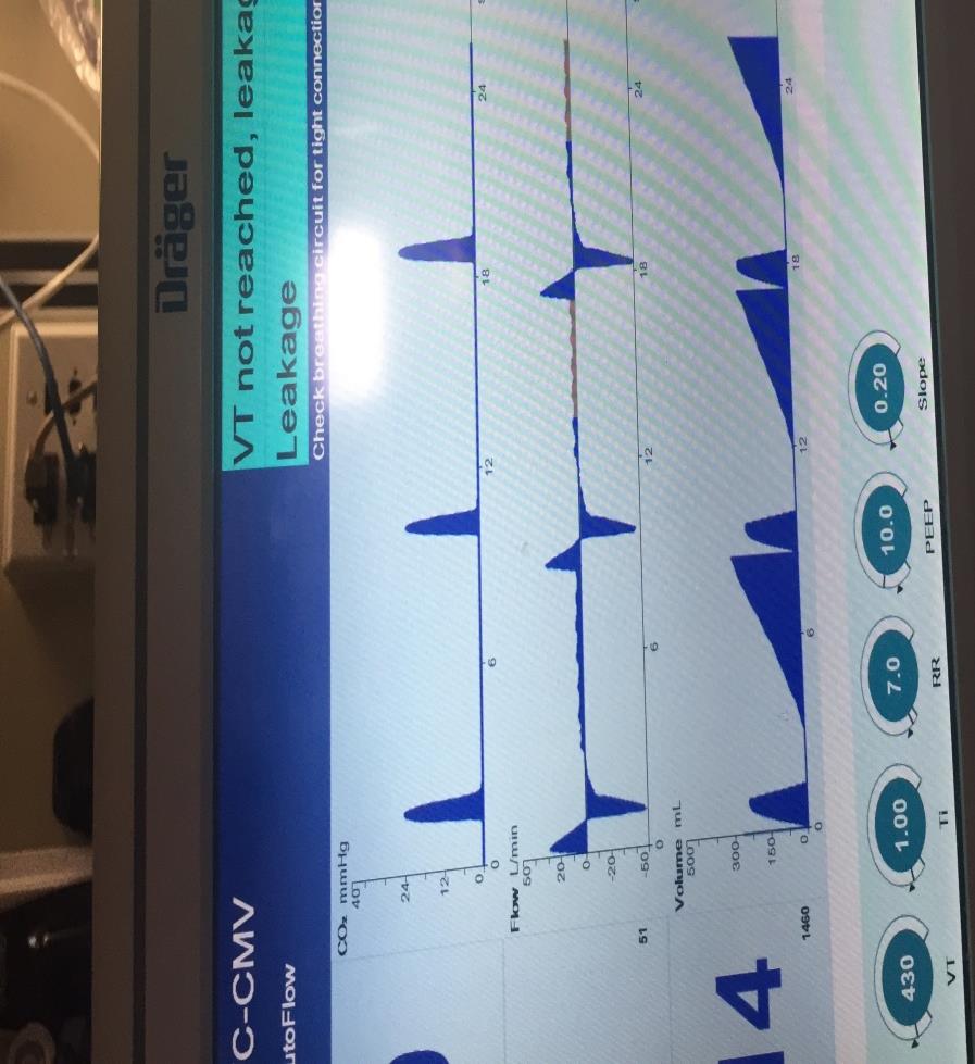 Figure 1: Here is the ventilator graphic display showing the capnogram, flow and volume traces from top to bottom. The red arrow represents the volume given by the ventilator (approximately 225 ml) and it is accompanied by the proper capnographic and flow traces. The blue arrow represents the volume integrated from the flow trace secondary to the leak (300 ml). You can appreciate that there is inspiratory flow after exhalation as the ventilator tries to keep the airway pressure at Peep level.
