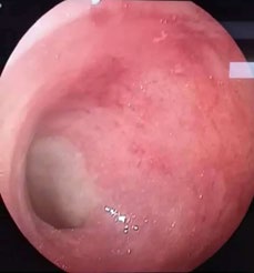 Figure 1: Erythematous edematous rectal mucosa with clear boundary of the rest of the mucosa (arrows).