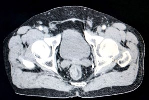 Figure 3: Control colonoscopy with normal rectal mucosa.