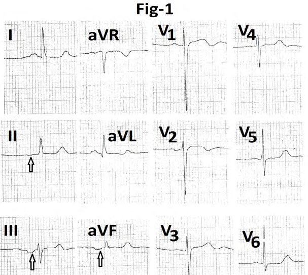 Figure 1: 12 lead electrocardiogram showing P wave inversion in leads II, III, aVF (marked arrow).
