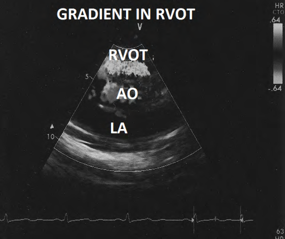 Figure 10: Short axis view showing turbulence in right ventricular outflow tract.