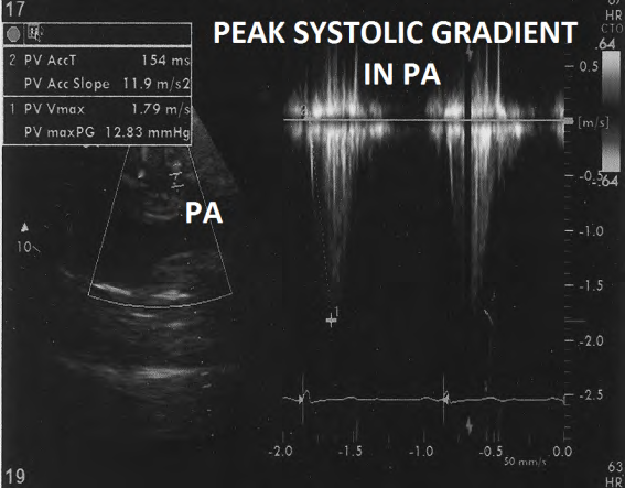 Figure 12: Doppler evaluation of pulmonary artery showing peak systolic gradient of 12.8 mm Hg.