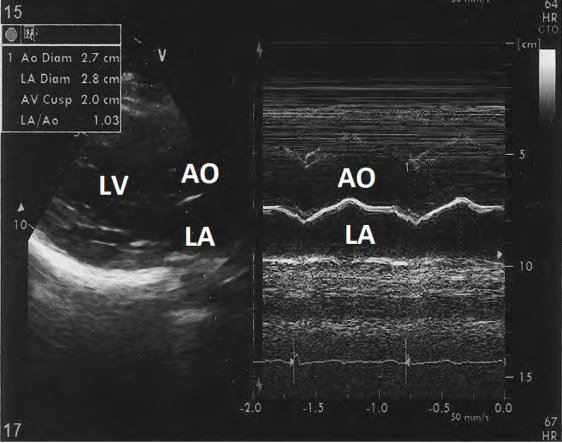 Figure 13: M-mode echocardiogram showing left atrial dimension of 2.8 cm.