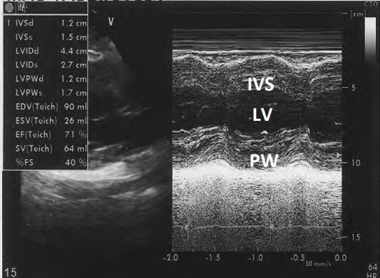 Figure 14: M-mode echocardiogram showing normal dimension and wall thickness of left ventricle.