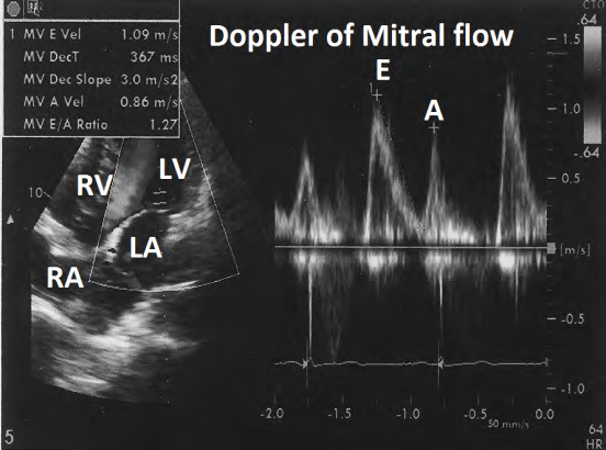 Figure 15: Showing Doppler evaluation of mitral flow showing normal pattern.
