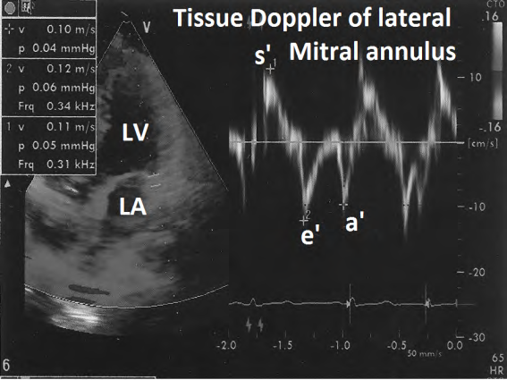 Figure 16: Tissue Doppler evaluation of lateral mitral annulus showing normal pattern.