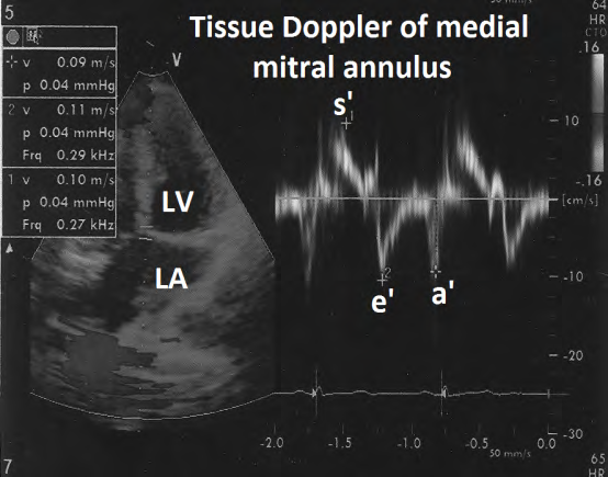 Figure 17: Tissue Doppler evaluation of medial mitral annulus showing normal pattern.