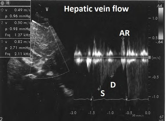 Figure 3: Showing normal hepatic vein flow pattern. S- Systolic, D- Diastolic, AR-atrial reversal.