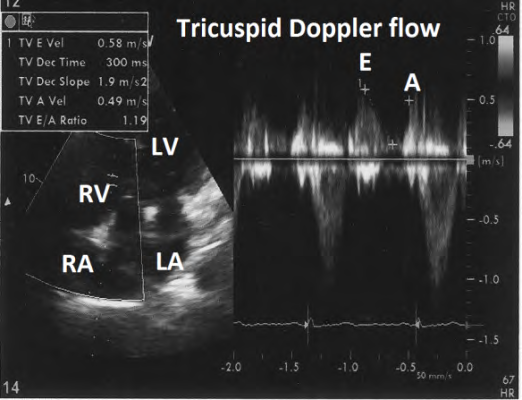 Figure 4: showing normal tricuspid Doppler flow. E- early diastolic flow, A-flow during atrial systolic.