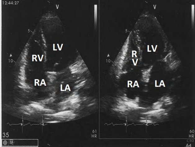 Figure 7: Apical four chamber view showing increased thickness and systolic obliteration of apex of right ventricle.
