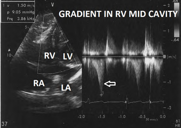 Figure 9: Doppler evaluation showing right ventricular med cavity systolic gradient of 9mm Hg(marked arrow).