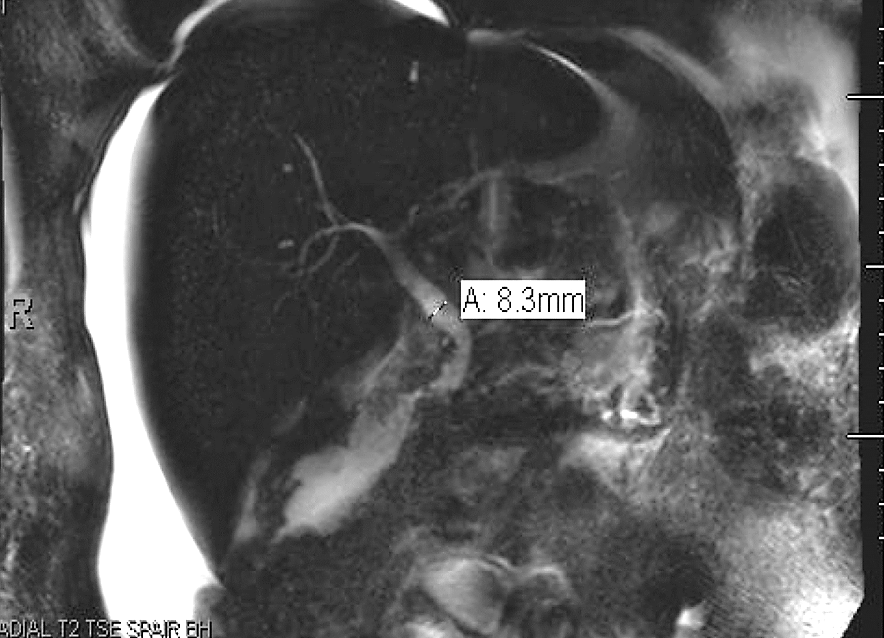 Figure 1: Magnetic resonance cholangiopancreatography (MRCP) shows a mild dilatation of the common bile duct with smooth tapering.