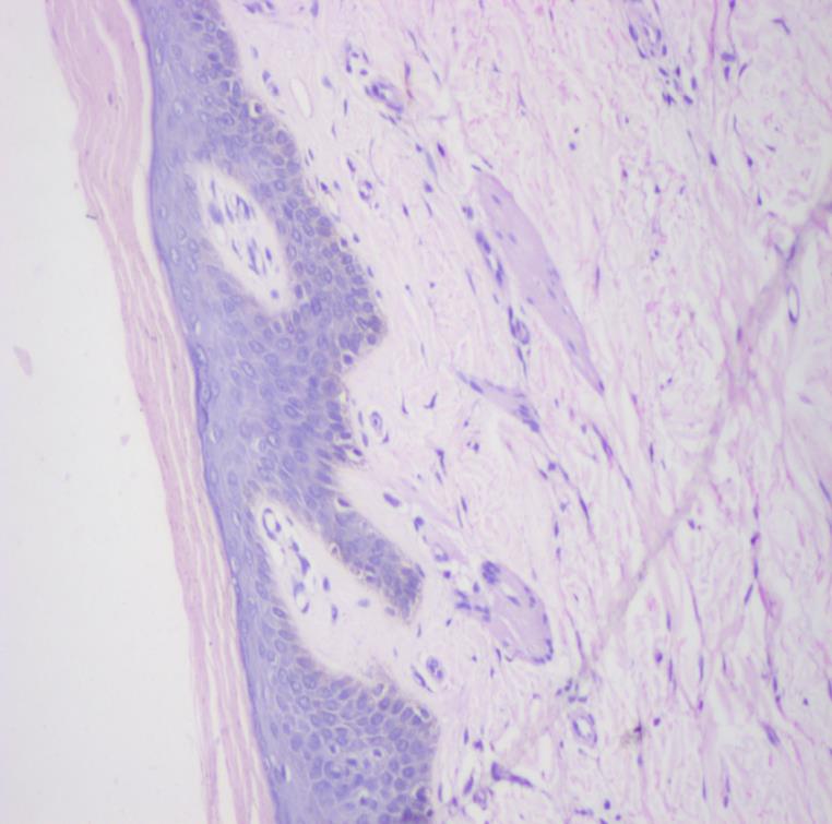 Figure 3: HPE of skin showing vacuolated keratinocytes. (H & E stain 40X).