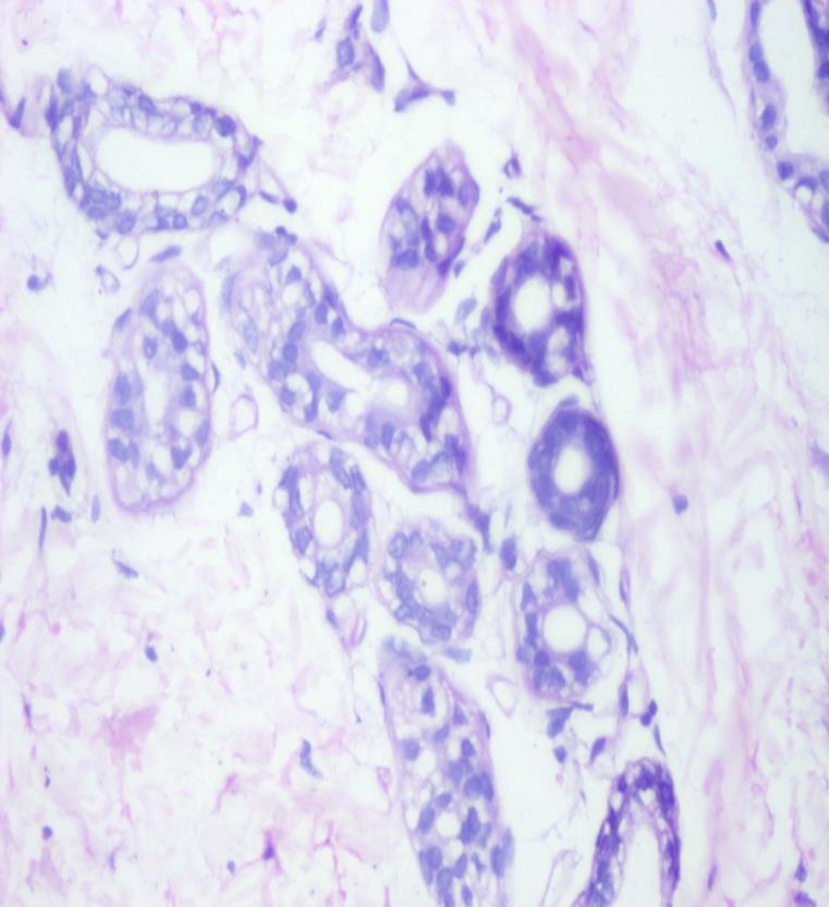 Figure 4: HPE of skin showingvacuolated eccrine gland cells. (H & E 100X).